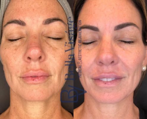 Dermapeel-BeforeAfter-Jan24