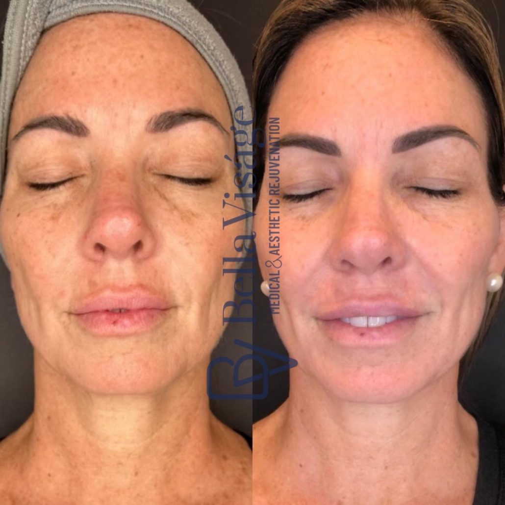 Dermapeel-BeforeAfter-Jan24