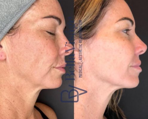 Dermapeel-BeforeAfter-Jan24-2