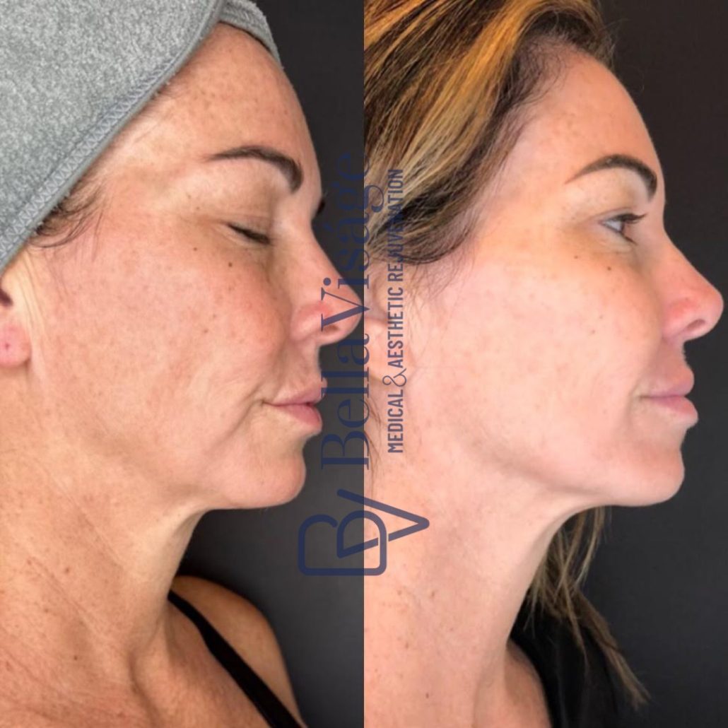 Dermapeel-BeforeAfter-Jan24-2