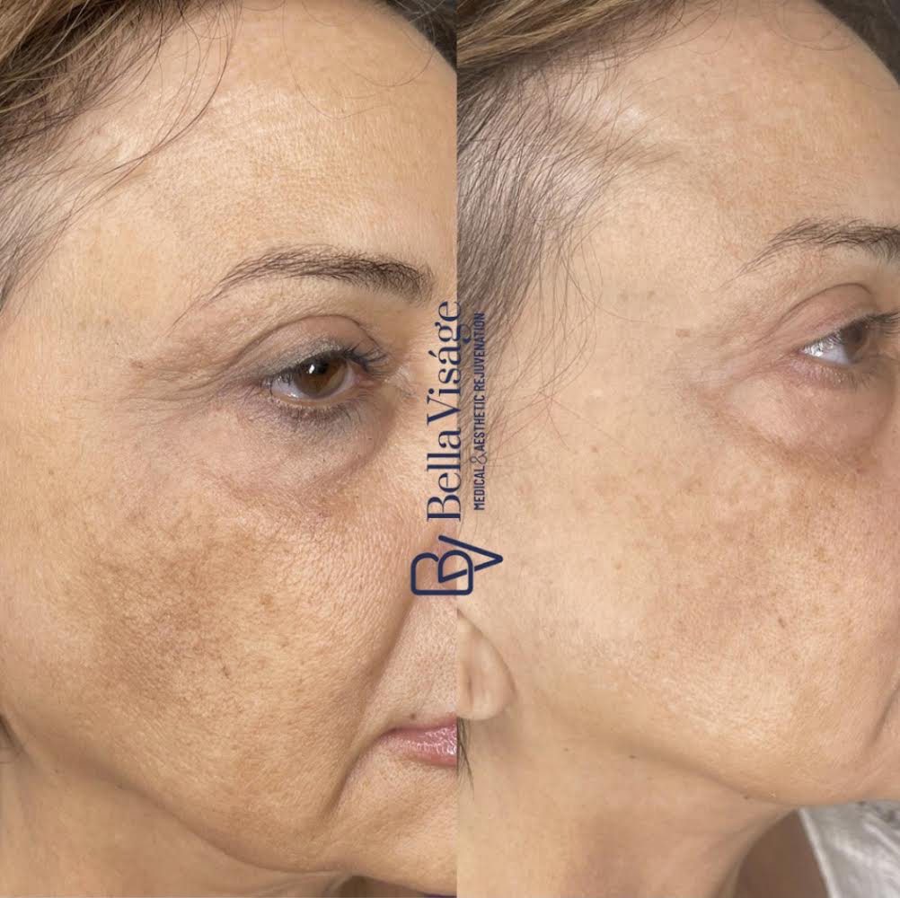 Dermapeel-BeforeAfter-Jan24-3