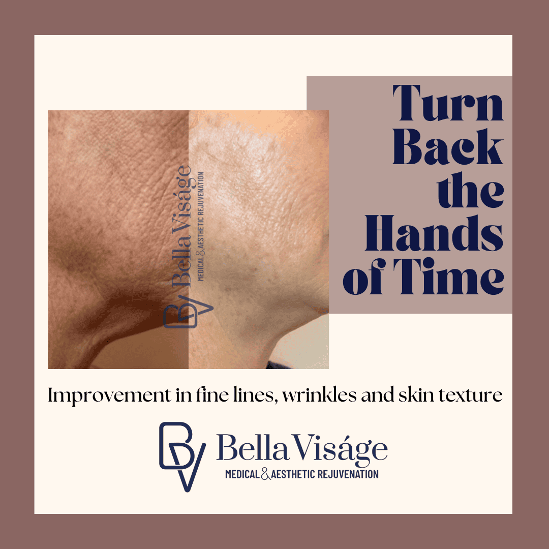 Virtue RF Microneedling by Bella Visage