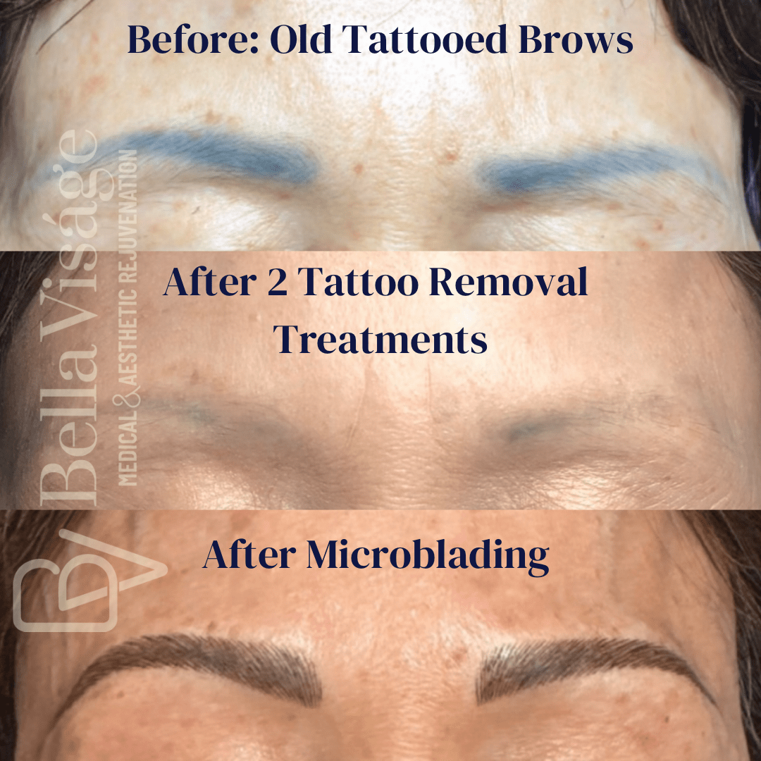 Say Goodbye to Unwanted and tattooed Brows