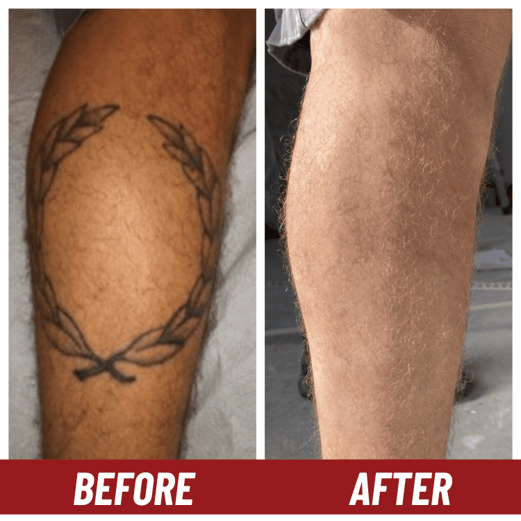 Tattoo removal in Lakeland before and after