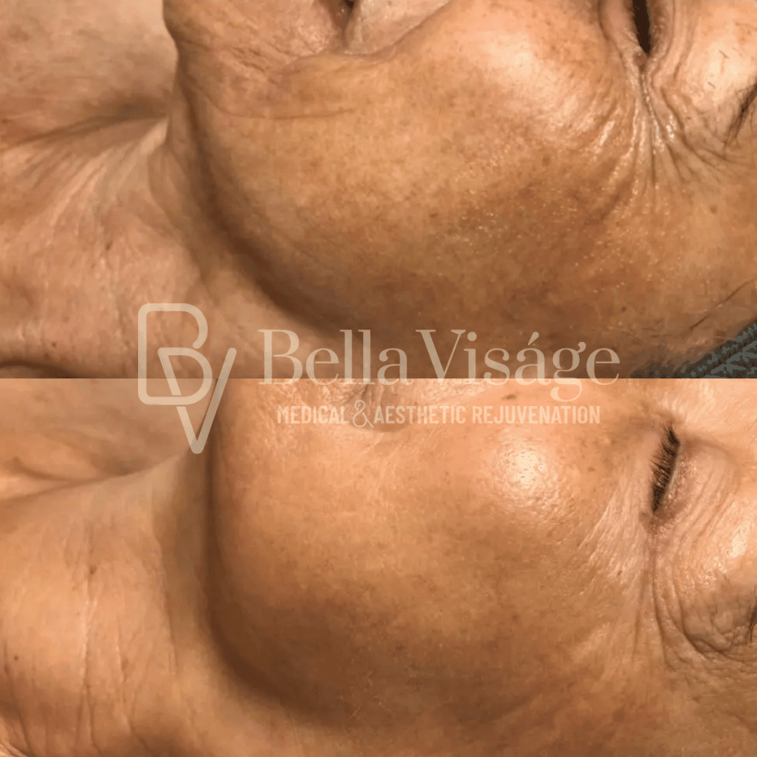 Tattoo removal in Lakeland Veterans