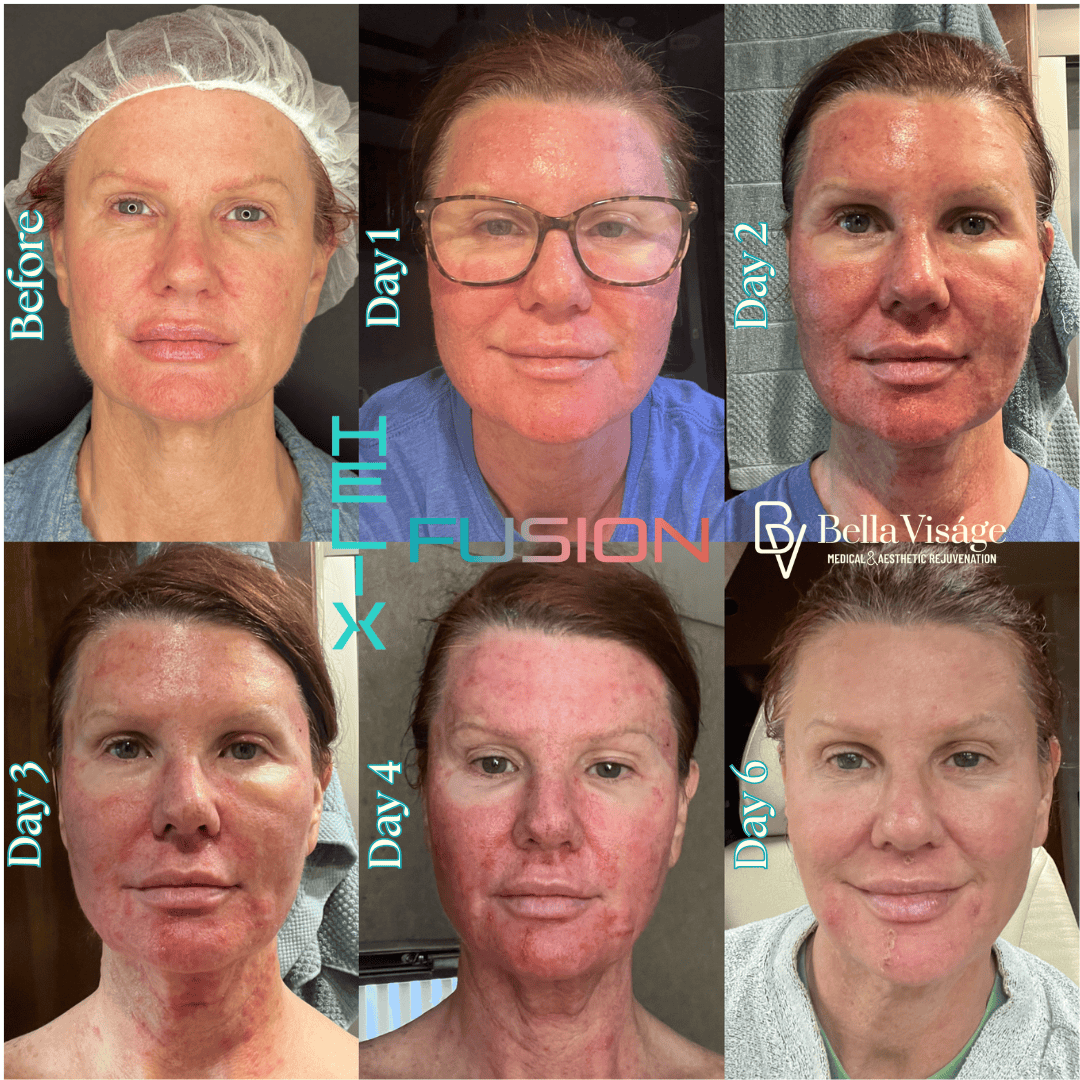 bella-helix-ba-2 Tattoo removal in Lakeland Veterans