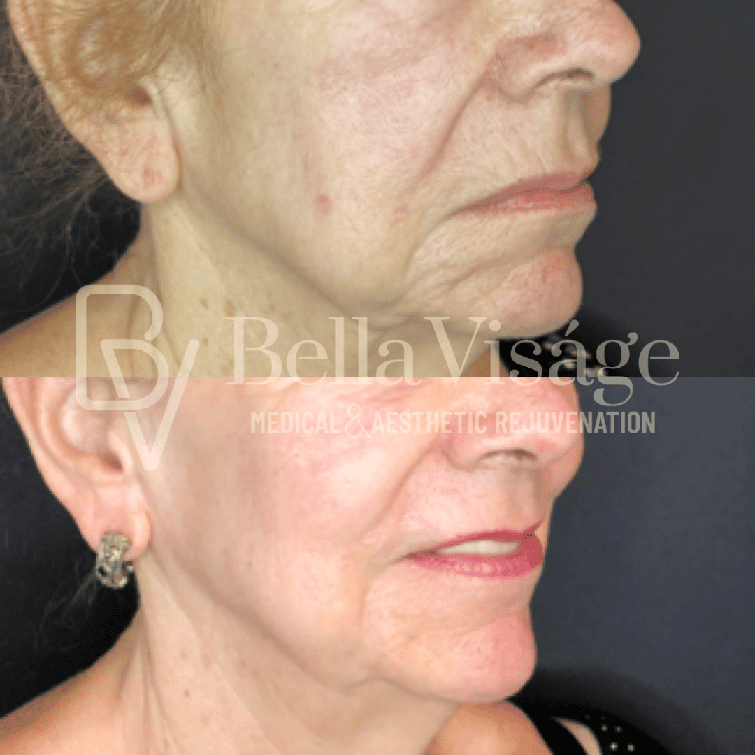 bella-helix-ba-9 Tattoo removal in Lakeland before and after