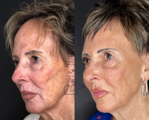 CO2 Resurfacing transformation